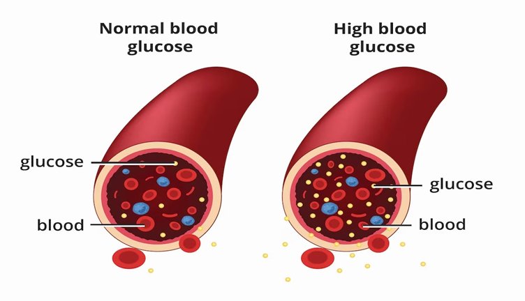 Illustration comparing normal blood glucose and high blood glucose levels in blood vessels.