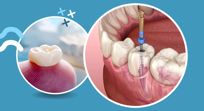 Illustration of a dental crown being placed on a tooth, alongside a diagram of a root canal procedure.
