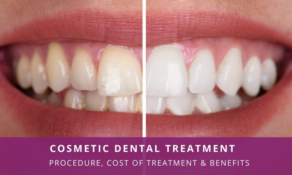 Close-up of a person's teeth before and after cosmetic dental treatment, showing significant whitening and alignment improvement.