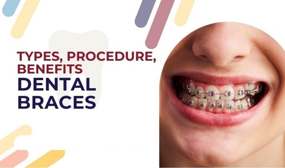 Closeup of a person smiling with dental braces on their teeth, accompanied by text about types, procedures, and benefits of dental braces
