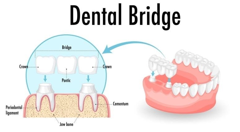 An illustration showing a dental bridge with crowns and pontic, along with a diagram of the dental bridge placed in the mouth.