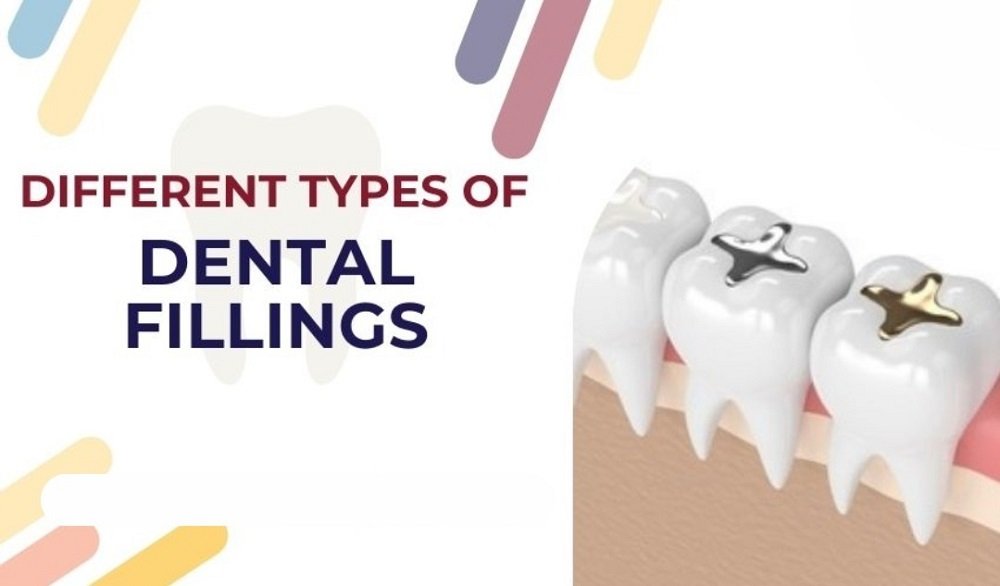 An illustration showing different types of dental fillings in teeth, including silver amalgam and gold fillings.