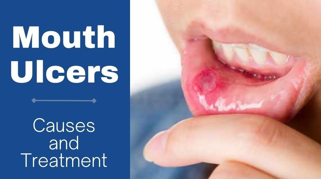 Close-up image of a person showing a mouth ulcer on the inside of their lower lip.
