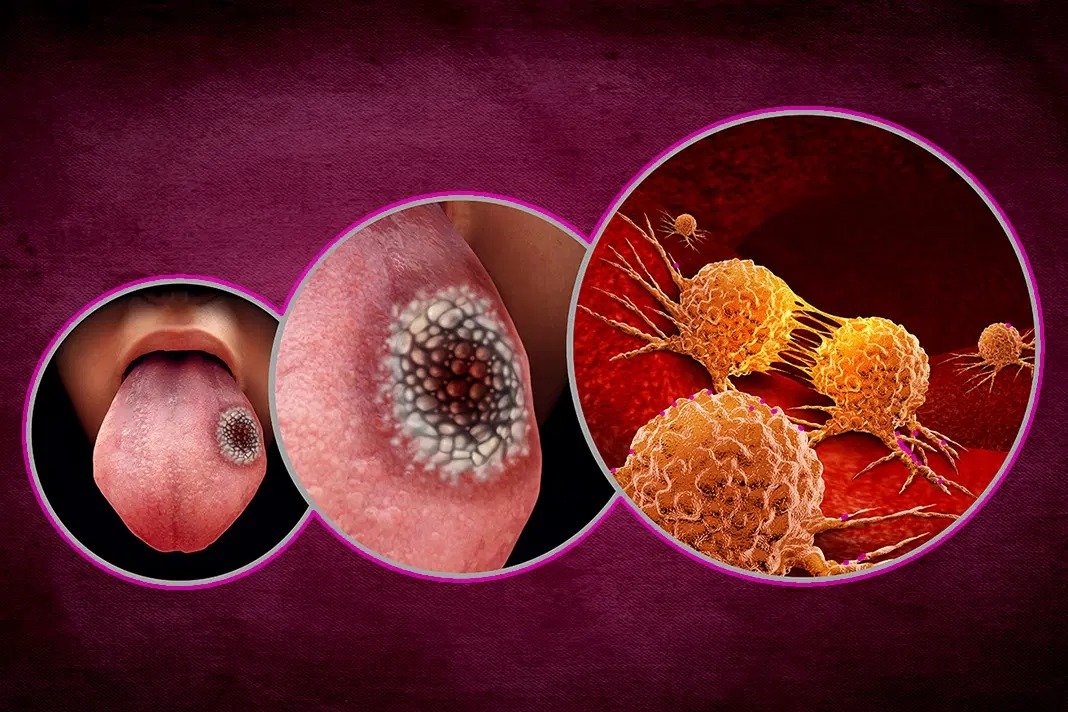A sequence of images showing oral cancer progression, including a lesion on the tongue and microscopic views of cancer cells.