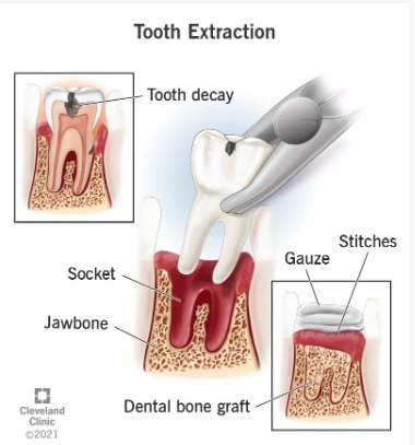 Diagram of a tooth extraction showing the jawbone, socket, stitches, gauze, and dental bone graft. Text on the image says: “Tooth Extraction” and lists reasons for extraction like “Tooth Decay.”