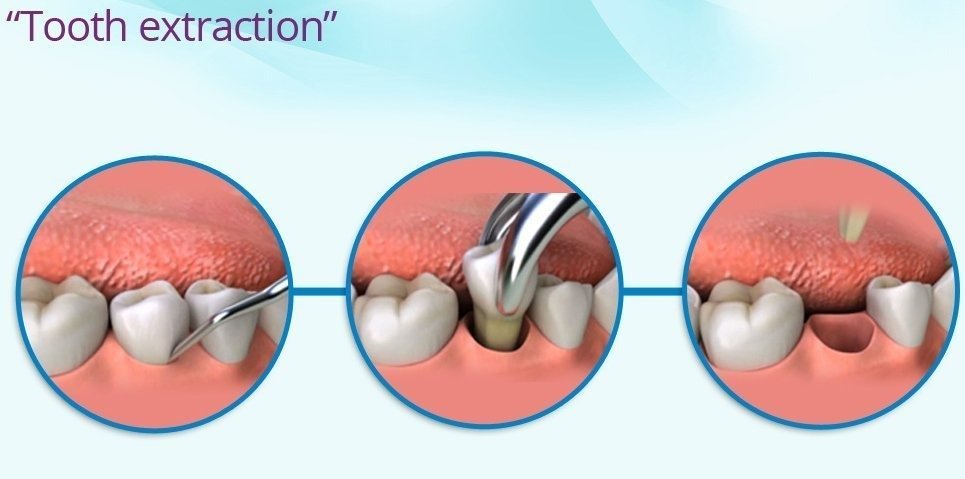 Illustration showing the process of tooth extraction, including the initial positioning of dental forceps, removal of the tooth, and the empty socket post-extraction.