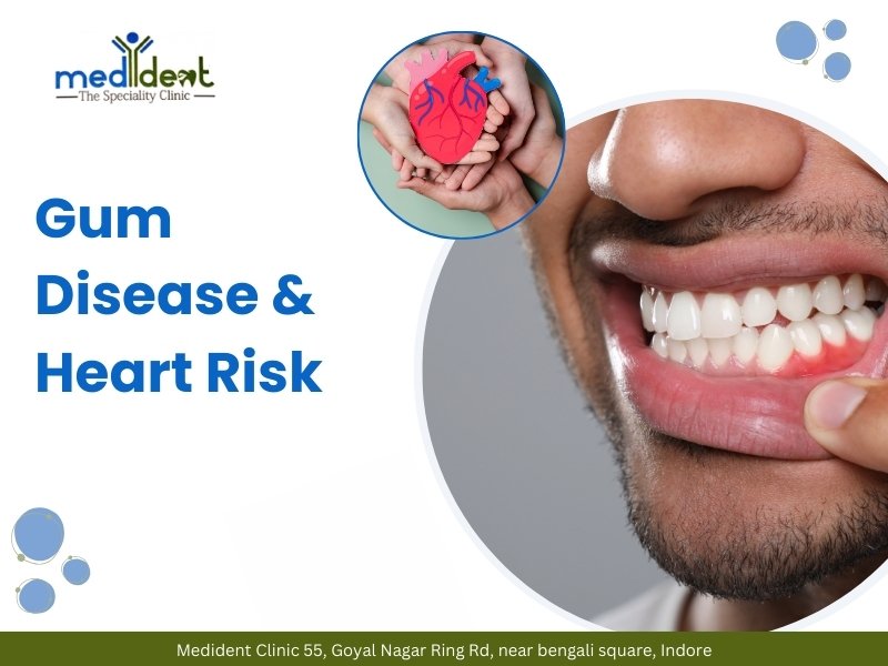 Swollen gums showing gum disease linked to increased heart disease risk
