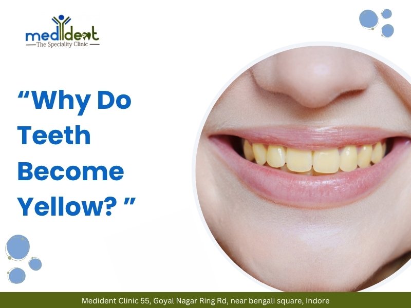 Yellow teeth problem explained by Dr. Priya Joshi with teeth whitening treatment in Indore for brighter smile